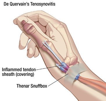 The ligaments at the joints of the thumb are all treated with acupuncture for thumb pain and repetetive strain