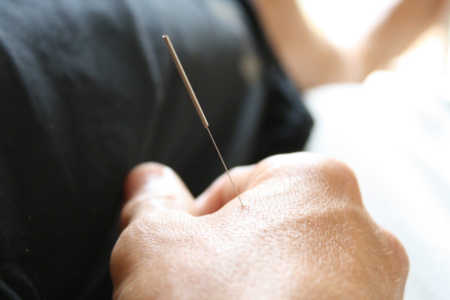 hand with an acupuncture needle placed in the point called LI4