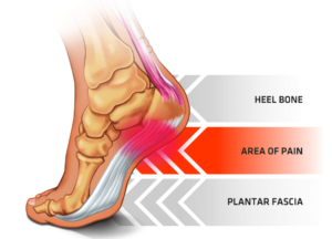 red area at the underside of the heel shows where the plantar fascia becomes inflammed