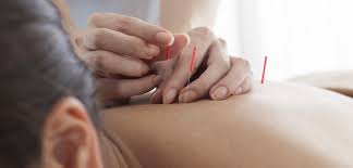 hands performing acupuncture on a womans back
