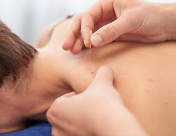 Dry Needling a Trigger Point in the Upper Trapezius