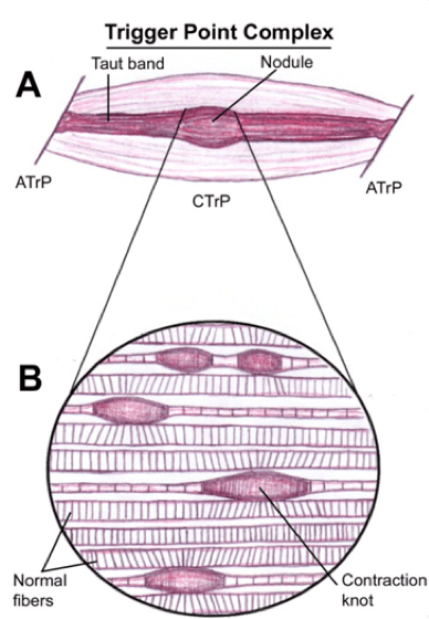 picture of a trigger point in a taugh band of muscle tissue