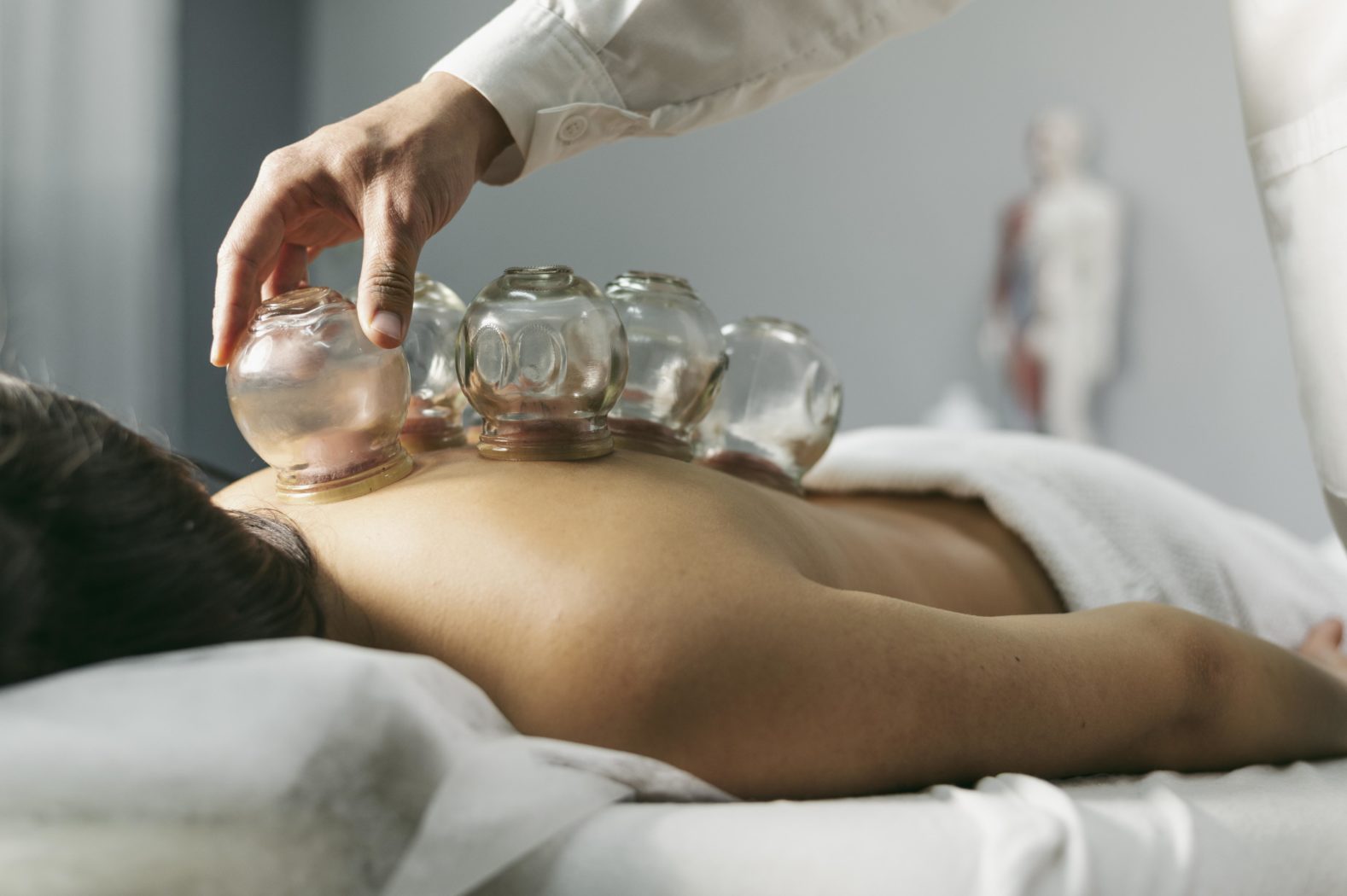 Woman lying prone on a massage table recieving cupping therapy