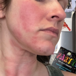 Woman with rosacea, before microneedling