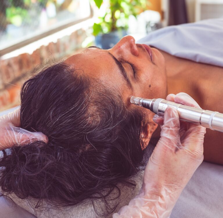 woman getting microneedling done to her face
