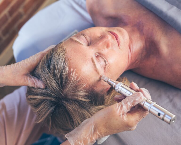 woman getting microneedling done on the fine lines on the outside of her eyes