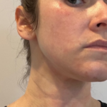 woman with rosacea improved after microneedling