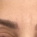 lines between a woman's eyebrows after microneedling