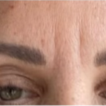 LInes between a woman's eyebrows, before microneedling