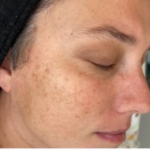 woman with sun damage on her cheek, before microneedling
