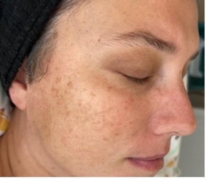woman with sun damage on her cheek, before microneedling