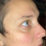 woman with improved skin after microneedling